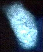 Breast X-ray