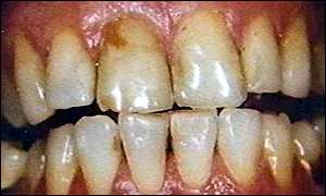 Teeth