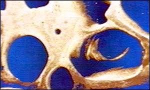 bone