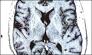 Brain areas