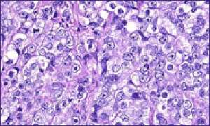 Prostate cancer