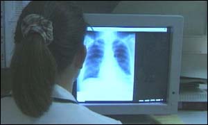 Chest x-ray