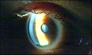 eye