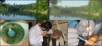 د سترګو پرده