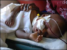Baby Vanessa undergoing treatment for pneumonia