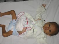 एड्स से पीड़ित वियतनाम की एक बच्ची