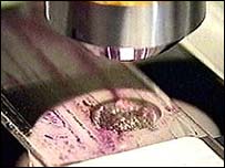 سلول های سرطانی