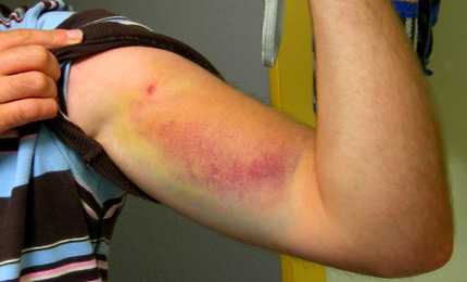 Bad etiquette comes home to roost. Here, local man Peter M shows what happens when a longboarder ditches regardless in a busy lineup. Peter couldn't duck dive deep enough, and caught the full weight of the board, nose-on. Folks, control your boards as much as possible when you ditch. France Oct 06