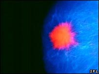 چھاتیوں کا کینسر