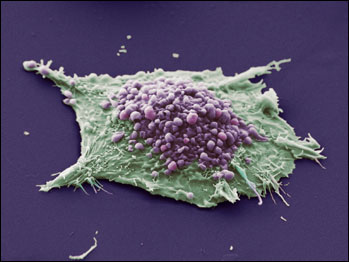 Câncer de pulmão (Foto: Anne Weston/Wellcome Image Awards 2009)