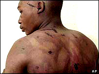 Zimbabveli bir işkence mağduru