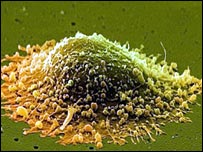 پروسٹیٹ کینسر کا خلیہ