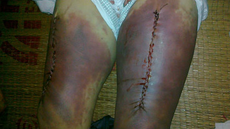 Ảnh hai đùi bị bầm dập của ông Nguyễn Mậu Thuận do gia đình chụp lại