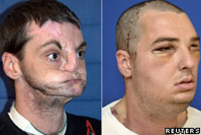 Richard Norris: before transplant (L) and after transplant (R)