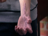 Injured hand and arm