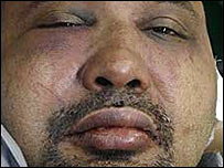 Bruised face of Keith Noyahr