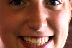 Alison can't wait to get her brace removed but will it be all smiles?