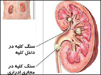سنگ گرده 