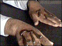 جونک سے علاج 