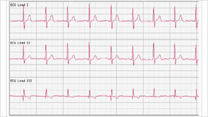 Chart showing Rory Cellan-Jones' heartbeat