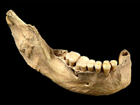 استخوان آرواره عکس از PANS