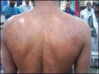 آرسینک کی زیادہ مقدار سے جِلد کی بیماری عام بات ہے۔ 