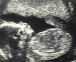 Baby ultrasound scan