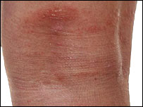 Pele machucada devido à natação