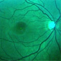 A damaged retina
