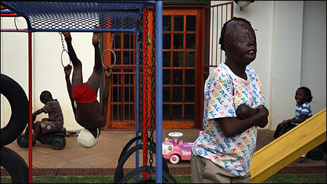 Burns survivor Dorah Mokoena in a playground in South Africa in 2009. Dorah, now age 16, was burned and disfigured in a squatter camp fire in South Africa when she was 7 months old and has since had multiple operations. Photo John Moore/Getty Images