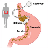 Gastric band procedure : Source Bospa