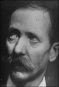 الوئيس گِلوگر دريافت کننده نخستين پيوند موفق قرنيه در جهان