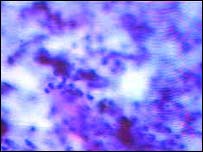 سلول های سرطانی رحم