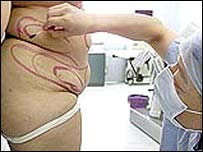 علامت گذاری روی بدن فردی چاق