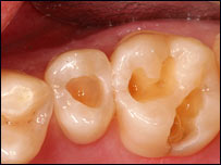 پوسيدگی دندان ها 