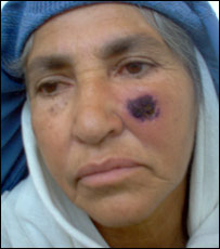 تداوی و وقايه سالدانه