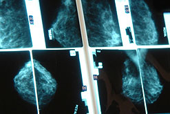 Breast Cancer