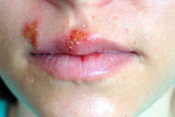 Cold sores, caused by a form of the herpes virus
