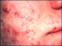 Pele com acne