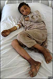 افغان قصبے گرشک میں زخمی بچہ