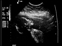 scan of foetus