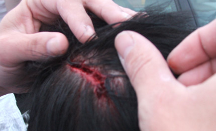 Just as we were talking recently about how lucky our lineup seemed to be in staying free of injuries, this happens. Rory from Liquid Surf Co got badly finned in the drop zone, ending up with a serious cut that needed stapled in hospital. Everyone hopes its not too long before Rorys able to surf again. May 07 