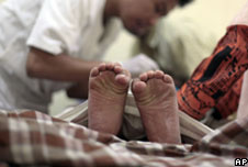 Discreet photo of circumcision