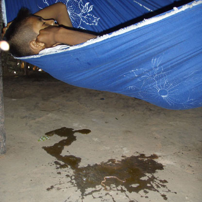 The son of the chief has been diagnosed with Vivax Malaria.